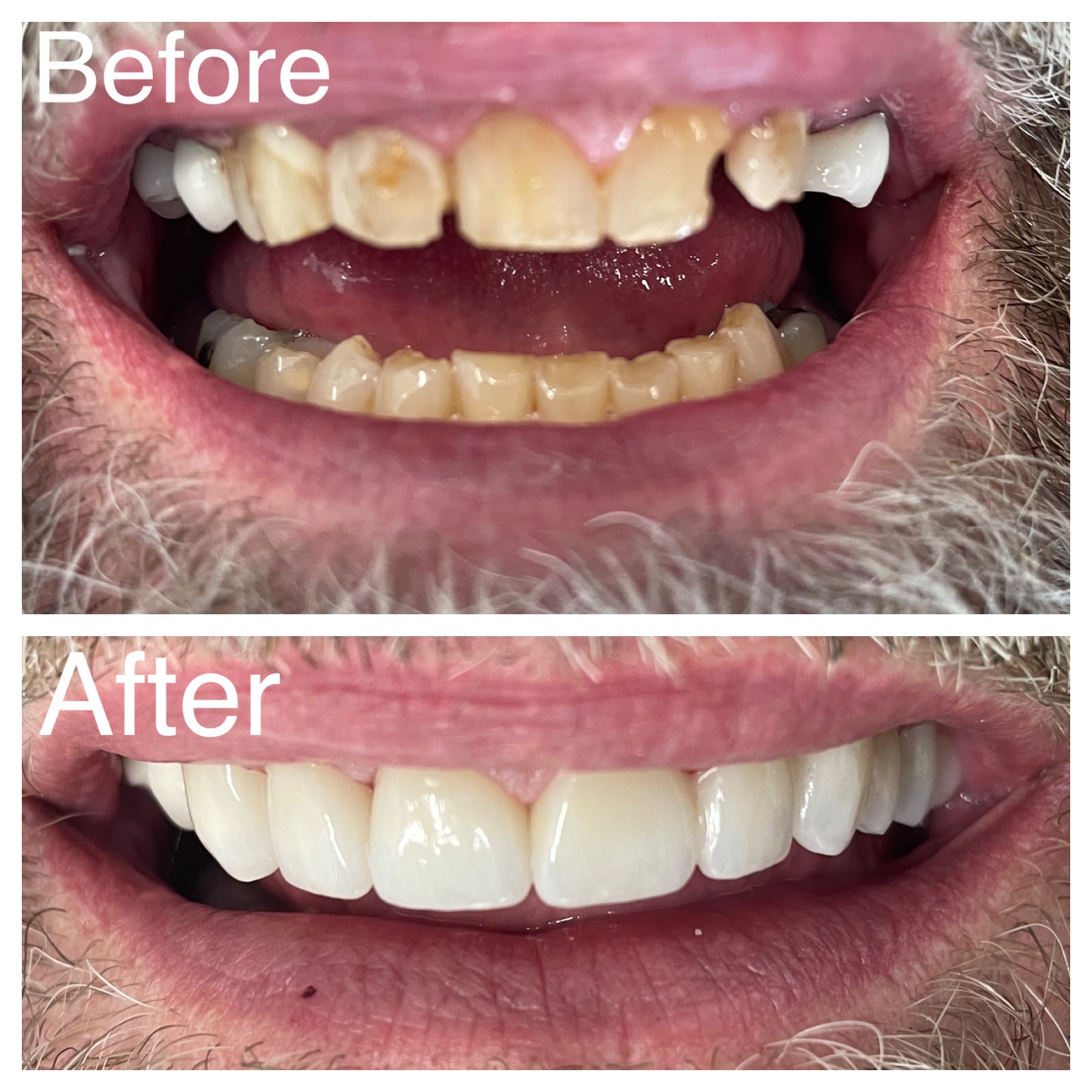 Patient before and after dental procedures