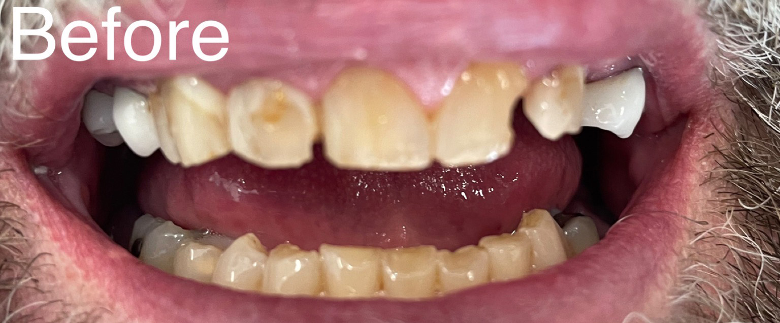 Patient's mouth before dental procedures