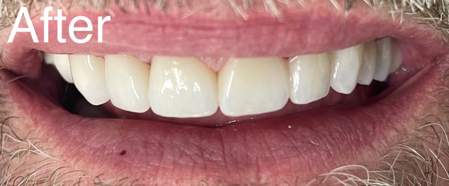 Patient's mouth after dental procedures